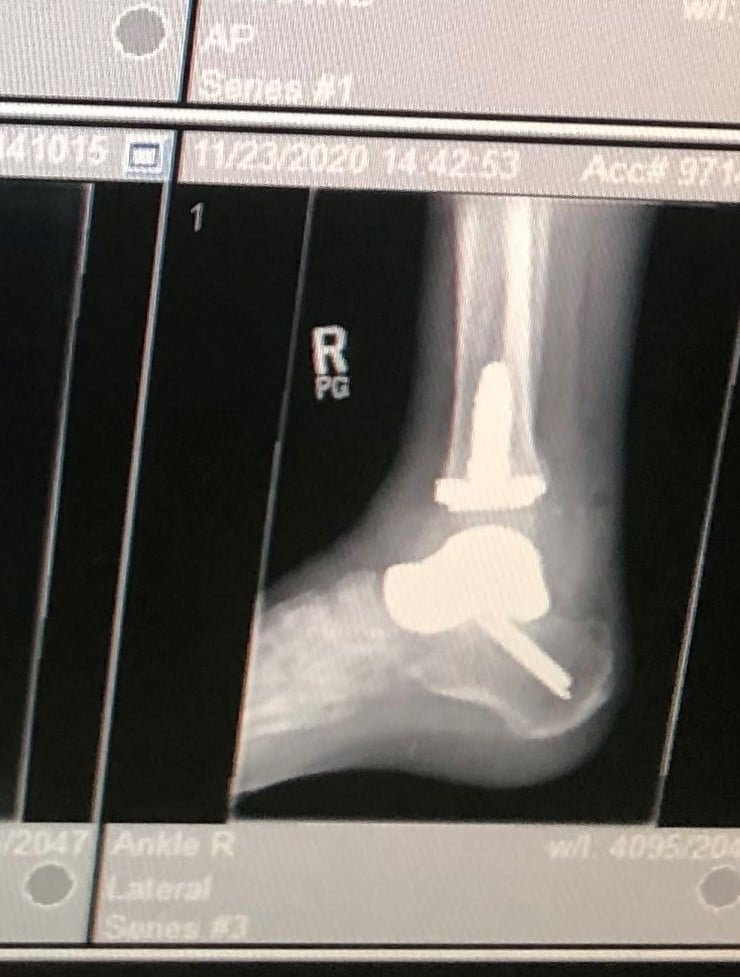 Ankle-a.jpg