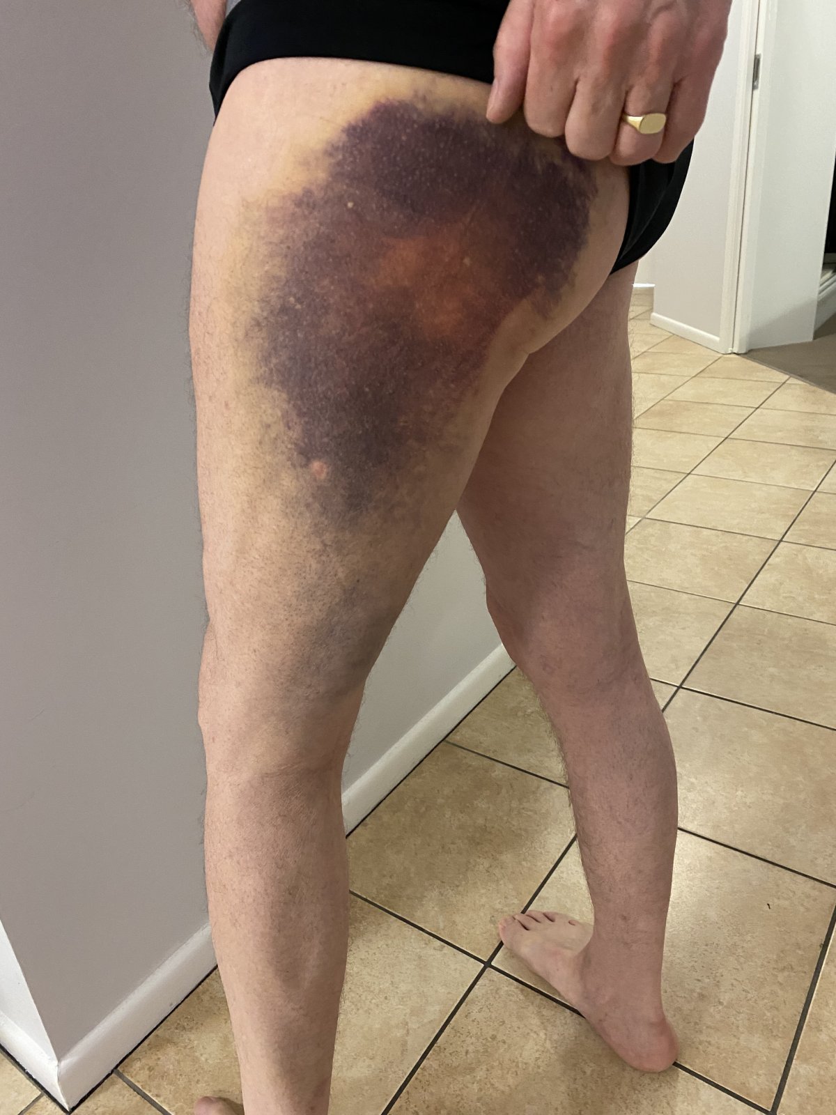 Bruise 4.jpg