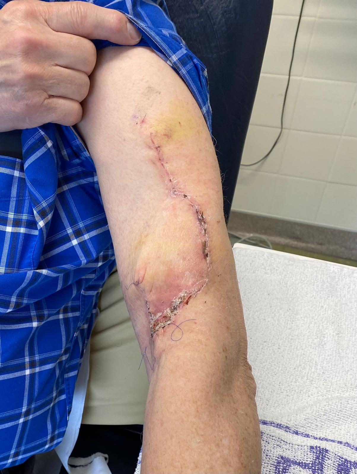 Elbow op + 19 days.jpg