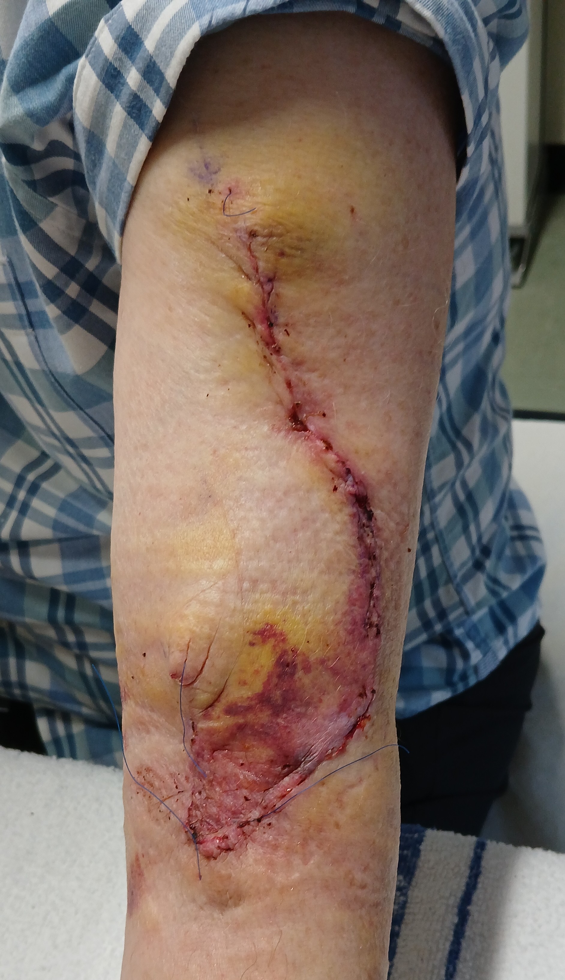 Elbow Scar.jpg