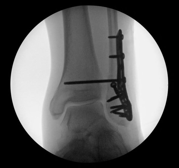 Fluoroscopy using a mobile II<1hr - Set 1 - Image 1.png